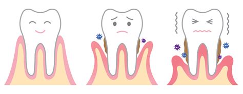 Understanding Periodontal Disease | Voyles Family Dental