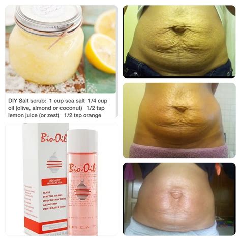 Bio Oil for Stretch Marks Her 10 year old stretch marks are almost completely gone in 32 days. # ...