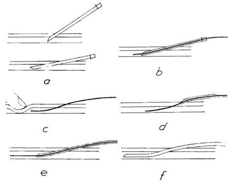 Seldinger Technique • LITFL • Medical Eponym Library