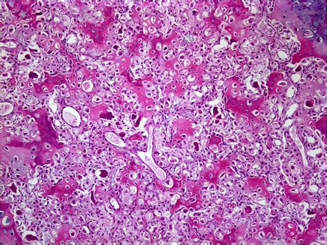 Chondrosarcoma - Pathology - Orthobullets