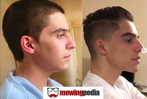 7 Mewing Before and After ideas | jawline, mew, jaw exercises