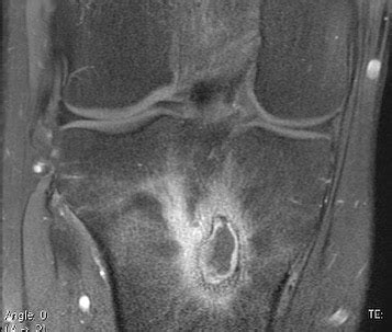 The Four MRI Layers of Subacute Osteomyelitis (Brodie’s Abscess ...