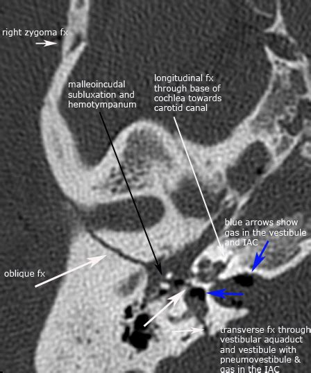 Temporal Bone Ct Anatomy - Anatomical Charts & Posters