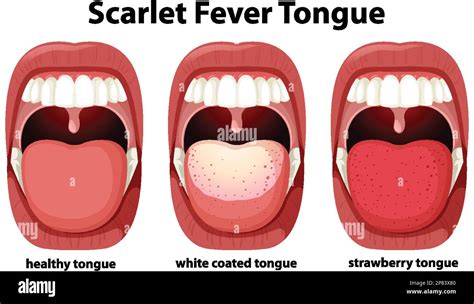 Scarlet fever tongue symptoms illustration Stock Vector Image & Art - Alamy