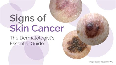 Melanoma Symptoms Early