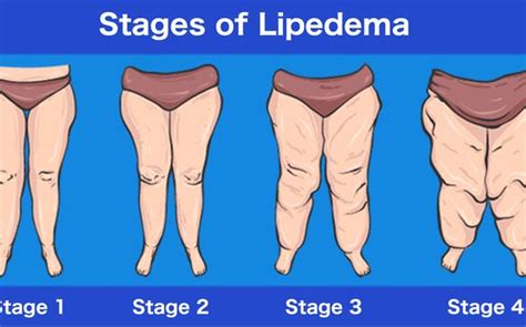 Remedies Lipedema Diet Stage