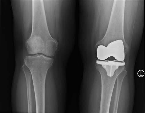 Mako Robotic Arm Assisted Total Knee Arthroplasty