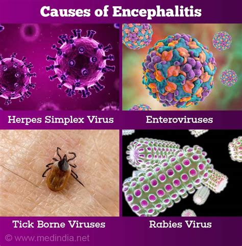 Here’s Everything You Need To Know About Encephalitis - ScoopWhoop