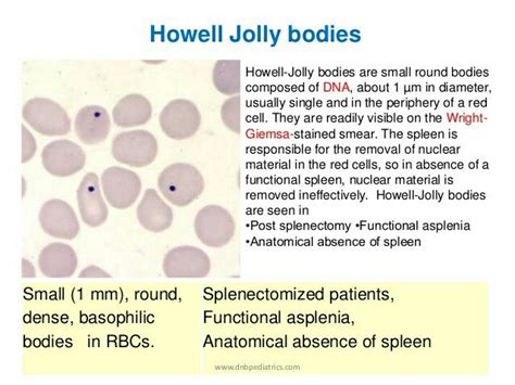 Howell Jolly bodies ( Nuclear remnants in RBC ) - Splenic dysfunction ... | Haematology ...