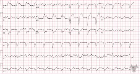 Sgarbossa Criteria | ECG Stampede