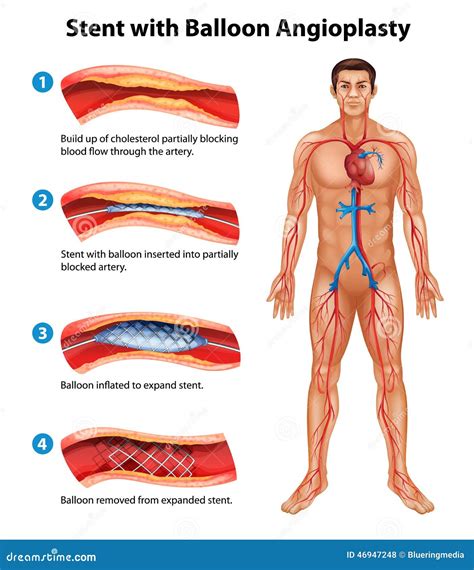 Stent Angioplasty Procedure Stock Vector - Image: 46947248