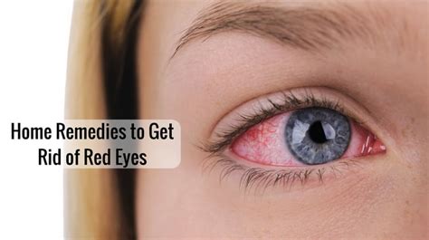 11 Best Remedies to Get Rid of Red Eyes Naturally