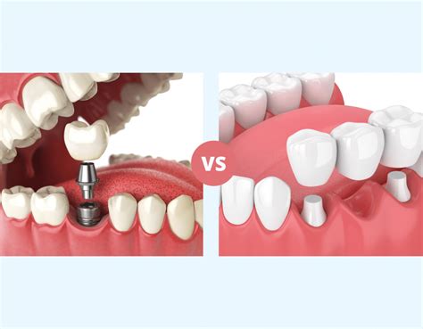 Dental Implants vs. Bridges Finding What’s Best for You