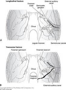 temporal bone fracture