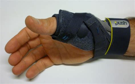 Ulnar Collateral Ligament Thumb Splint