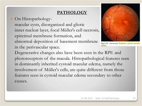 Cystoid macular oedema