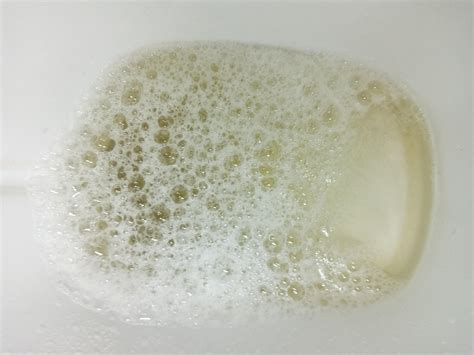 Foamy urine. Urinalysis comes with No Protein. What is the cause? | Scrolller