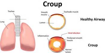 Croup - Acute Laryngotracheobronchitis