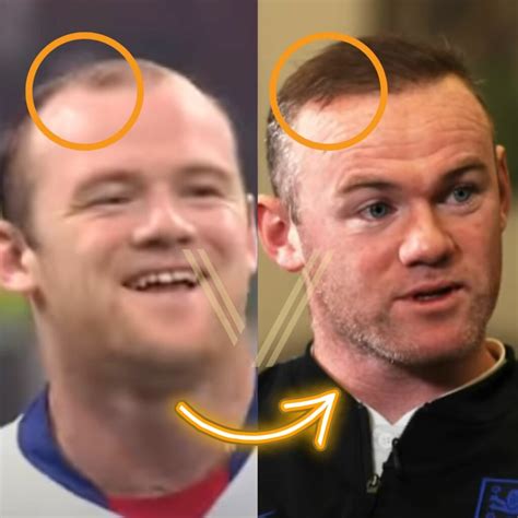 Wayne Rooney's Hair Transplant: Before and After Transformation