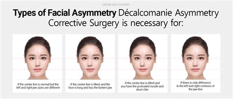 Asymmetrical Face Surgery Before And After