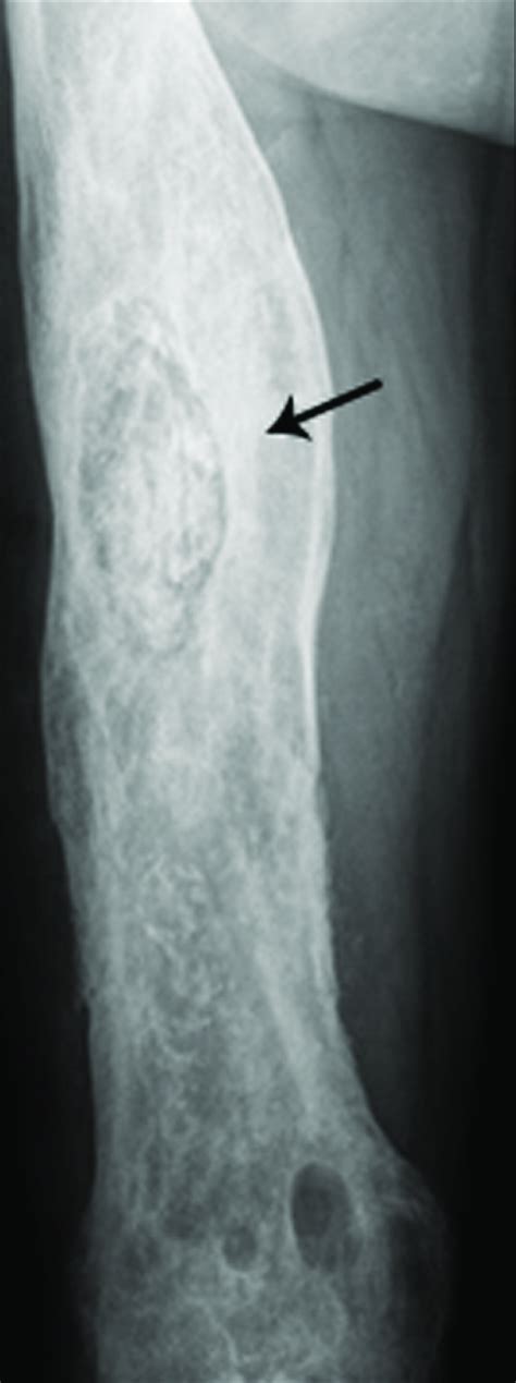 Osteomyelitis X Ray Features