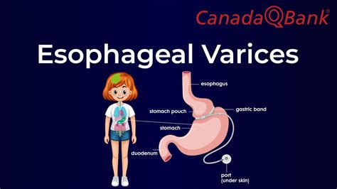 Esophageal Varices - YouTube