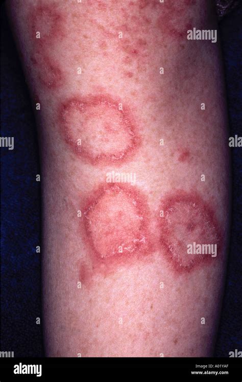 skin lesions discoid lupus 33 year old female Stock Photo: 3217326 - Alamy