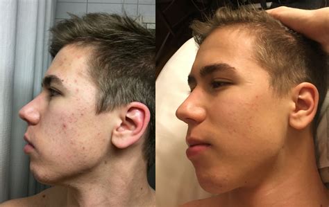 [B&A] 2 Months of low dosage Accutane for mild acne (20mg/day) 1 month left