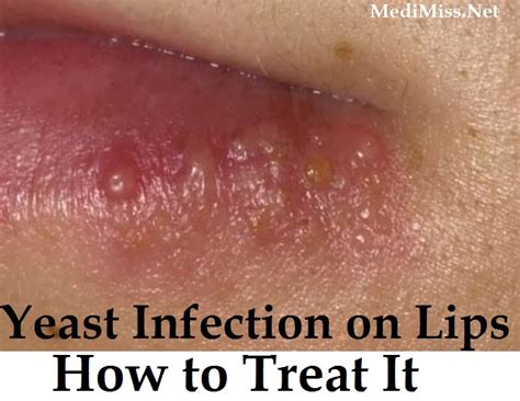 Yeast Infection on Lips - How to Treat It - SkinnyZine