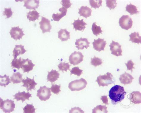 Spur Cell Anemia - 2.