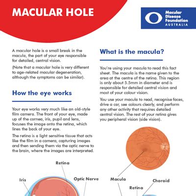 Macular hole | Macular Disease Foundation Australia Macular Disease ...