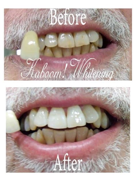 Teeth Bleaching Before And After