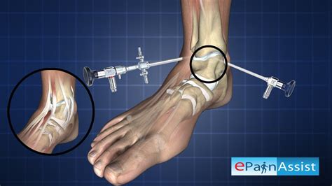 Ankle Arthroscopy-Diagnostic Procedure - YouTube