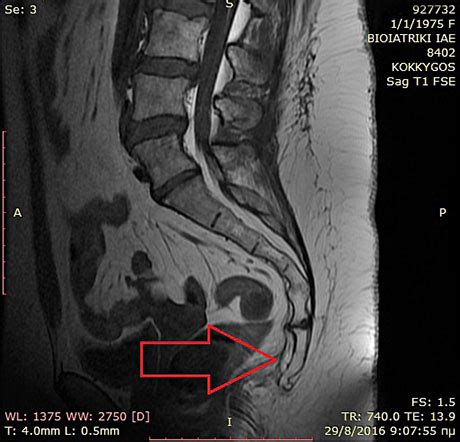 TAILBONE INJURY - COCCYX PAIN - COCCYDYNIA | GEORGE D. GOUDELIS MD. Ph.D.