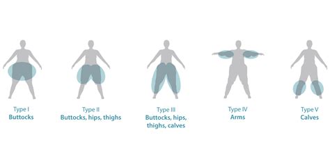 What is Lipedema? Lipedema Causes & Treatments | Tactile Medical