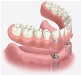 Loose Dentures? Ask Us About Dental Implants | Durham Implant Solutions