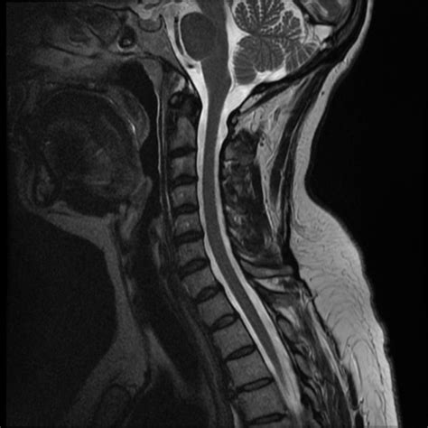 What to do with a normal MRI?