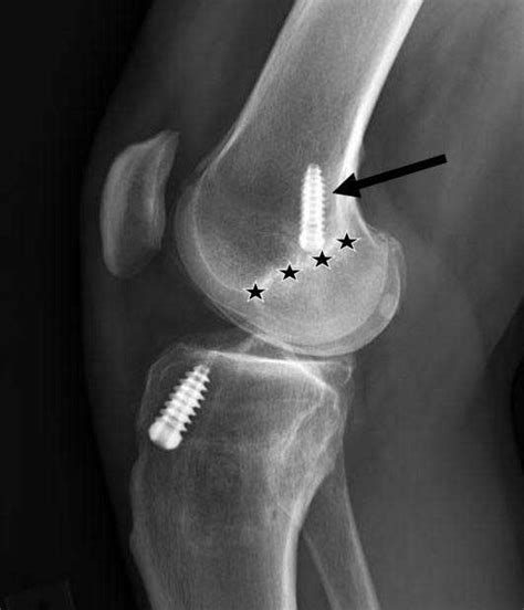 ACL Reconstruction | Anterior Cruciate Ligament Surgery | Knee ...