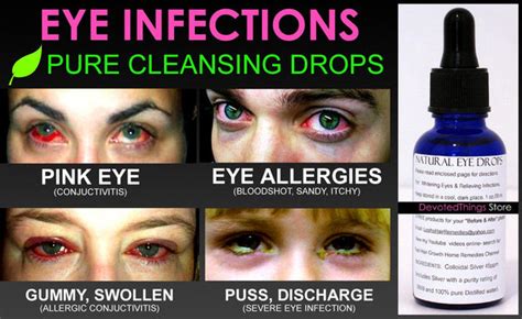 Natural Eye Drops for Pink Eye and Eye Infections for Healthy Bright ...