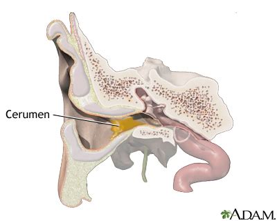 Ear wax: MedlinePlus Medical Encyclopedia