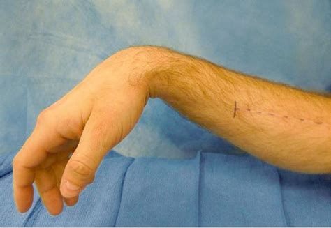 Radial Nerve Injury | Plastic Surgery Key