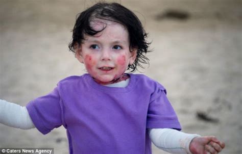 Girl, 6, suffers rare epidermolysis bullosa which makes skin blister at slightest touch | Daily ...