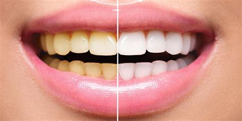 Do's, Dont's and side effects of professional teeth whitening | Onlymyhealth