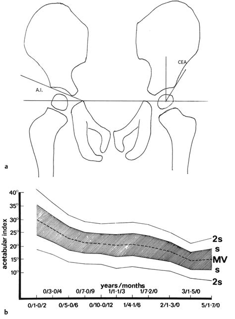 Disorders of Growth and Development in the Extremities | Musculoskeletal Key