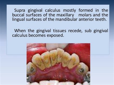 the primary cause of supragingival calculus formation is | Chicago Criminal and Civil Defense