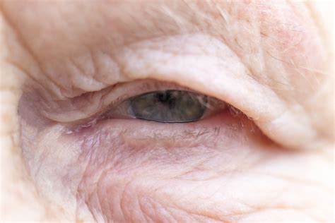 What To Do About Drooping Eyelids - Southside Eye Care