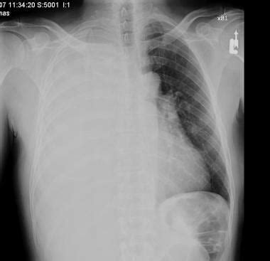 Pleural Effusion Treatment & Management: Approach Considerations ...