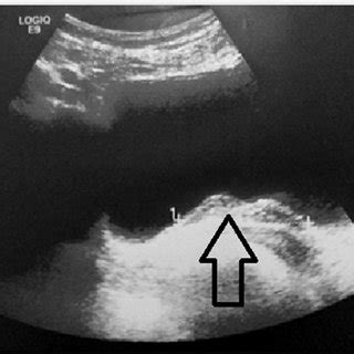 An exophytic mass in the bladder trigone measuring 43 Â 37 mm... | Download Scientific Diagram