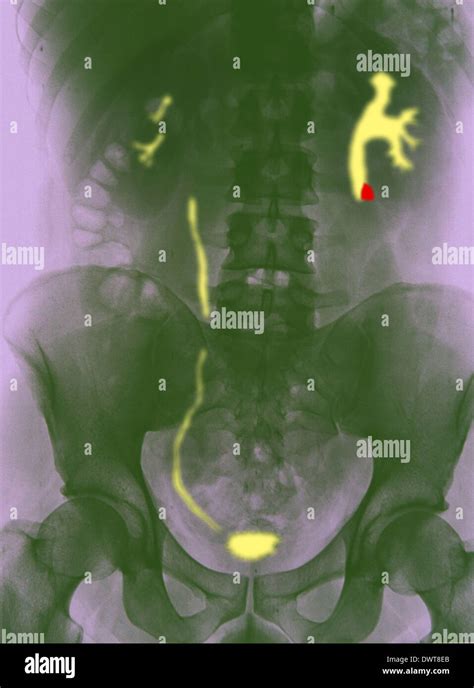 Kidney stone x ray Stock Photo - Alamy