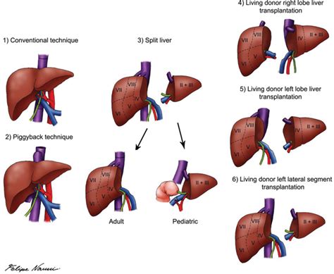 Pediatric Liver Transplantation | IntechOpen